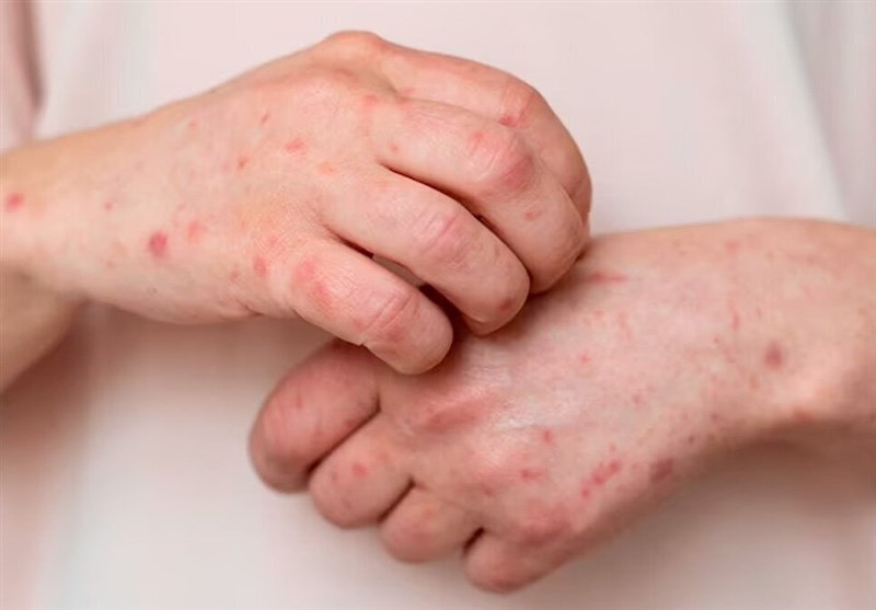 هوای پاییزی عامل افزایش ابتلا به آبلهمرغان هوای پاییزی عامل افزایش ابتلا به آبلهمرغان